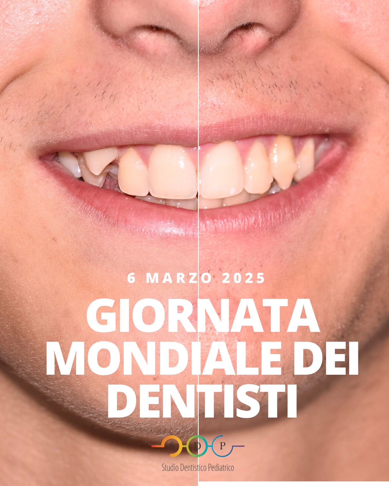 🌟 Oggi festeggiamo la Giornata Mondiale dei Dentisti! 🦷✨ Siamo felici di prenderci cura dei sorrisi più belli, quelli dei nostri piccoli pazienti! 😁🦷 Insieme costruiamo sorrisi sani e forti per un futuro radioso! #GiornataMondialeDeiDentisti #SorrisiSani #DentistaPediatrico #CuraDeiSorrisi”