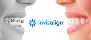 Terapia Ortodontica Invisalign