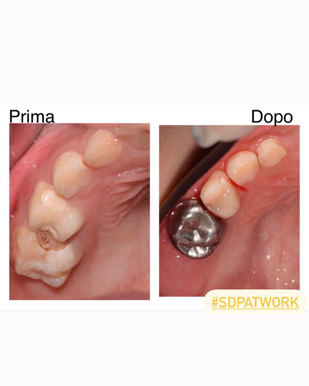 👑Quando in pedodonzia si utilizzano le coroncine metalliche?👑
 
🦷Quando il dente da latte è molto cariato e una normale ricostruzione non reggerrebbe nel tempo.
 
Vantaggi:
 ✅il dente è al sicuro sotto uno scudo inattaccabile.
✅La superficie liscia delle coroncine permette una buona e facile igiene.
✅Meno stress di ritrattamenti.
✅Viene preservata l’altezza della masticazione, importante per lo sviluppo di una corretta articolazione temporo-mandibolare.
✅Viene mantenuto intatto lo spazio per una corretta eruzione dei denti permanenti.
 
Svantaggi:
 
❌Poco estetica ma…Non resta in bocca tutta la vita!!.🤪