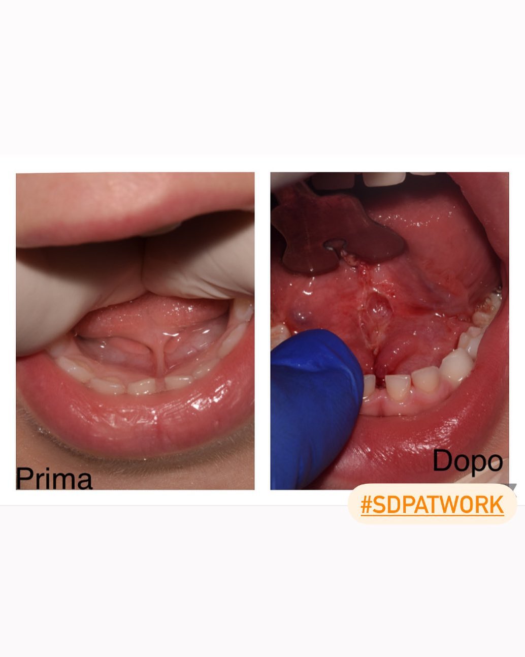 👅 Tutti nasciamo con il frenulo linguale ma questo non sempre è della giusta lunghezza ..📏
 
Un frenulo linguale corto può impedire il buon movimento della lingua.👄
 
🍼All’inizio impedisce la capacità di allattare e gestire bene il biberon ed in seguito di parlare e sviluppare correttamente la bocca.
 
Le figure professionali che si occupano del frenulo sono: 
👩🏻‍🍼Neonatologi
 
👅Logopedisti dell’infanzia.
 
🧑🏻‍⚕️Osteopati dell’infanzia
 
🦷Odontoiatri pediatrici.
