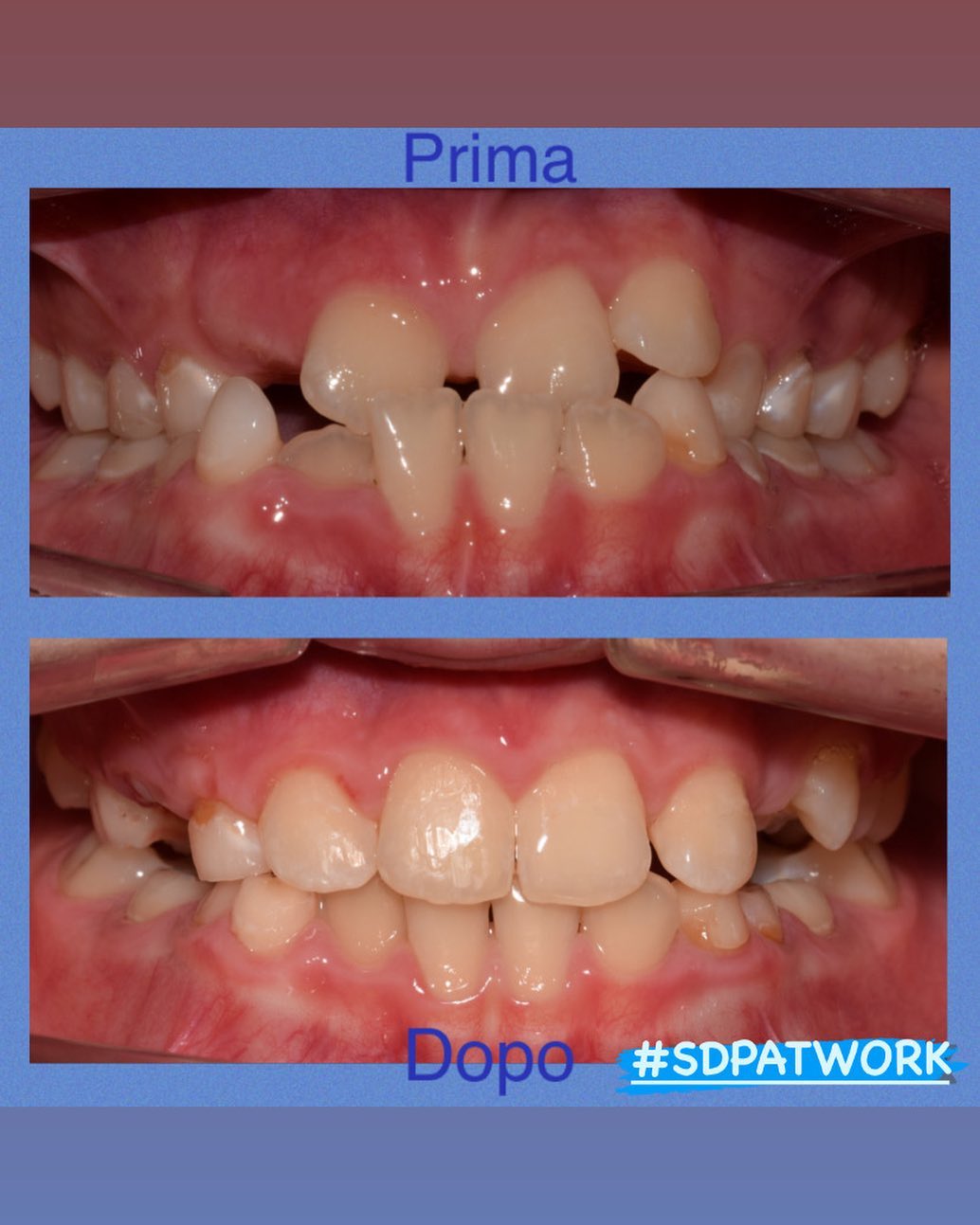 🦷Il morso inverso cos’è?

Immaginiamo che la bocca sia come una scatola🎁:il sopra è il coperchio ed il sotto è la base. Quando questo rapporto si rovescia abbiamo appunto un morso inverso.
Poiché dai circa 3 anni in poi la masticazione ha un andamento circolare ,avere in bocca un morso inverso impedisce una corretta ed efficiente funzione masticatoria ed un armonico sviluppo scheletrico.  Come si può risolvere ?
 ✅Va corretta quanto prima con un trattamento ortodontico 🤓